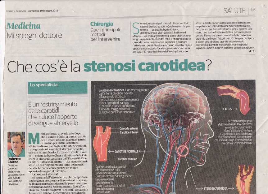 stenosi carotidea2136