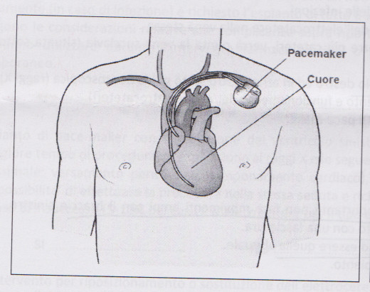 pacemaker 16 ott 192267